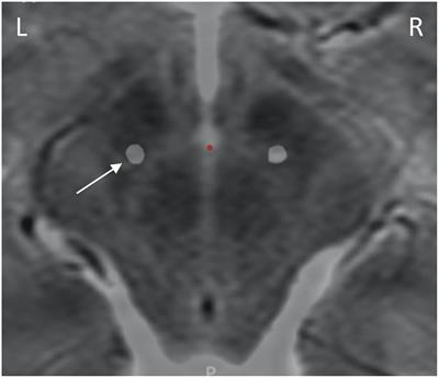 Chronic Sensing of Subthalamic Local Field Potentials: Comparison of First and Second Generation Implantable Bidirectional Systems Within a Single Subject